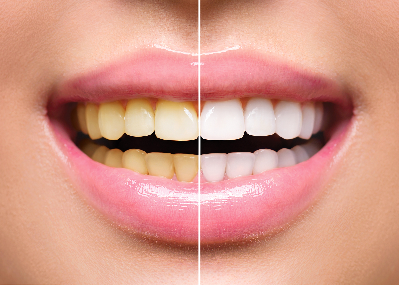 In office teeth whitening Less Stress DDS, City VoucherCart